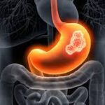 gastric cancer