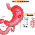 gastric ulcer