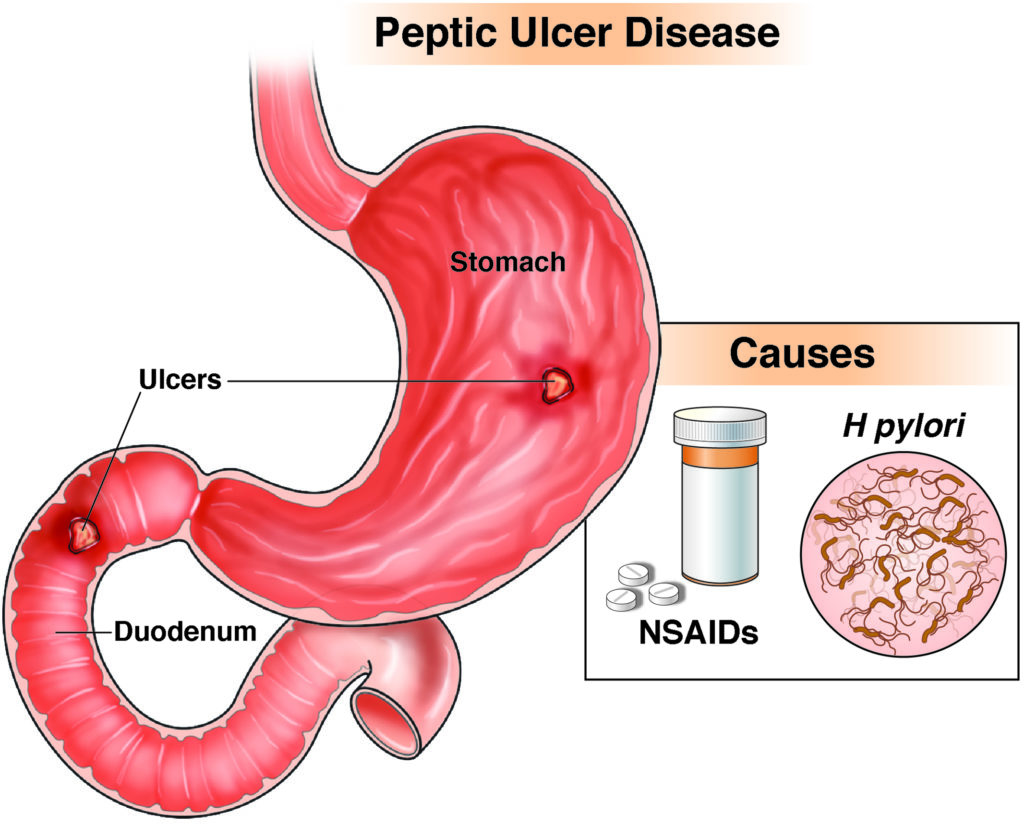 gastric ulcer