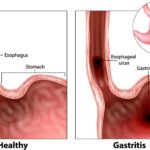 gastritis