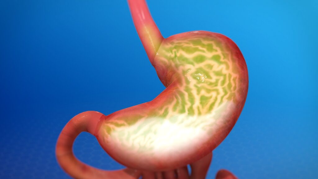 gastroesophageal reflux disease