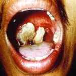 gastrointestinal anthrax