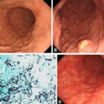 gastrointestinal candidiasis