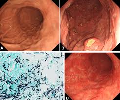 gastrointestinal candidiasis