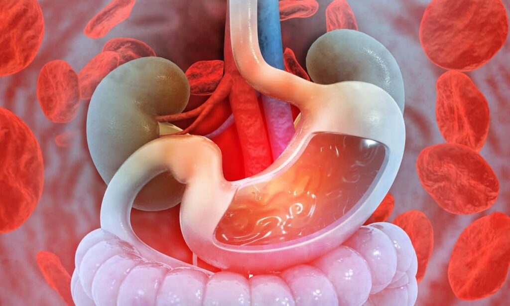 gastrointestinal hemorrhage