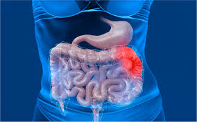 gastrointestinal stromal tumor