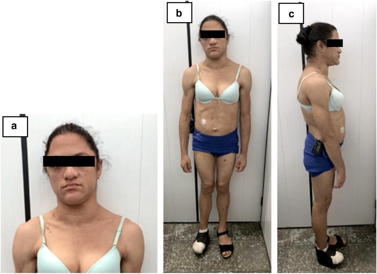 generalized lipodystrophy