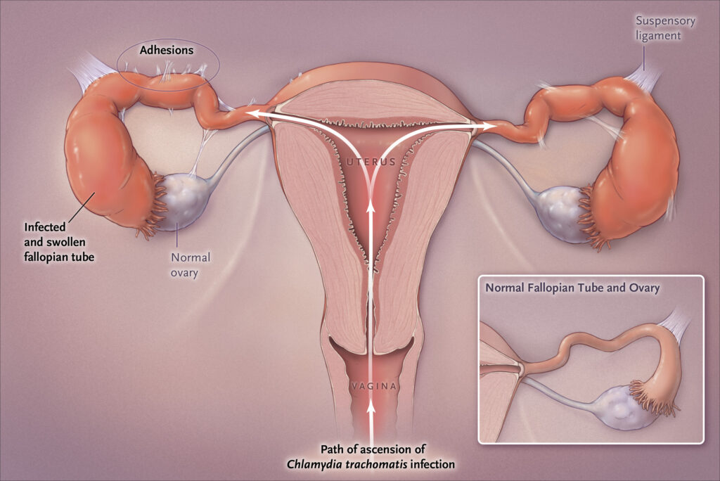 genitourinary chlamydia trachomatis infection