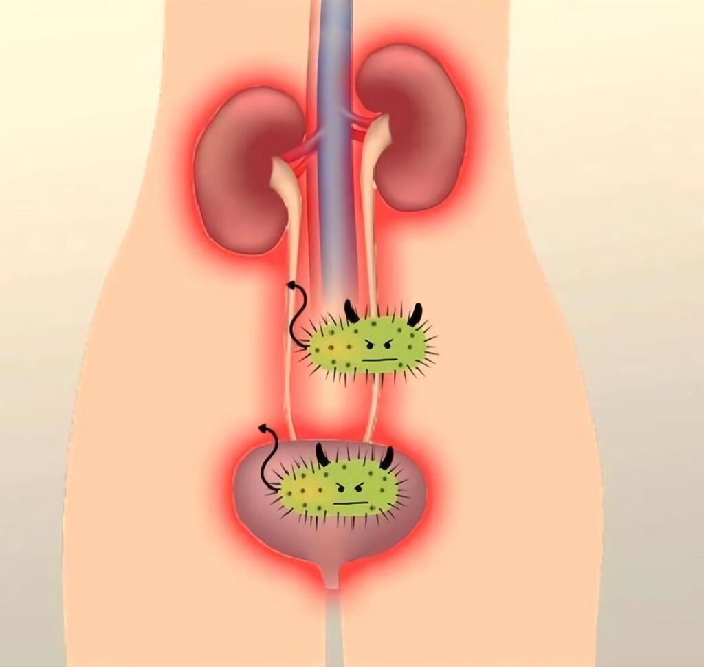 genitourinary tract infection due to proteus