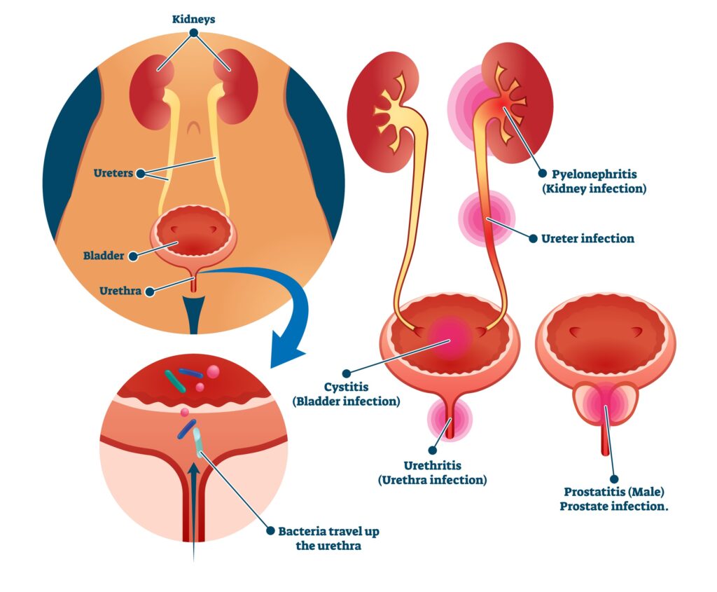 genitourinary tract infections