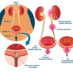 genitourinary tract infections