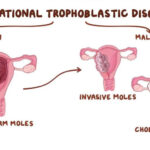 gestational trophoblastic neoplasia