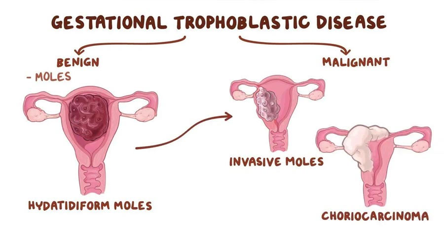 gestational trophoblastic neoplasia