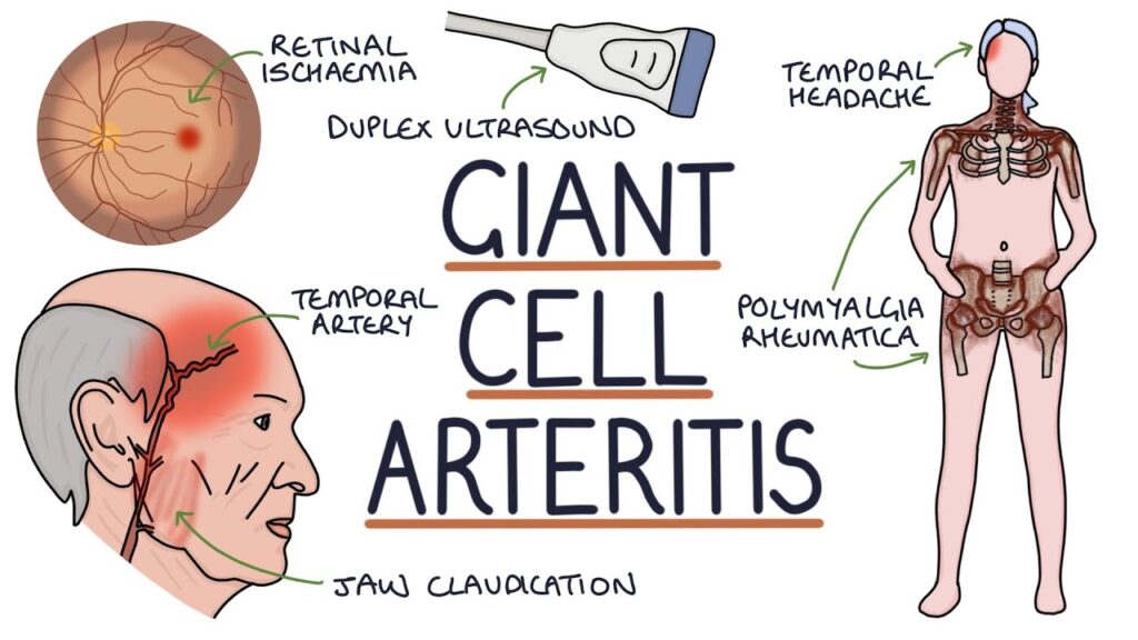 giant cell arteritis