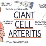 giant cell arteritis