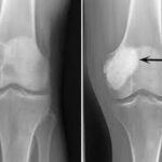 giant cell tumor of bone