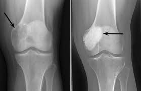 giant cell tumor of bone