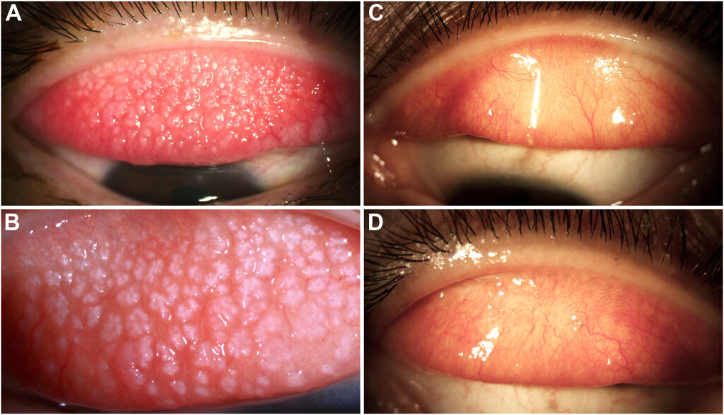 giant papillary conjunctivitis