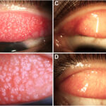 giant papillary conjunctivitis