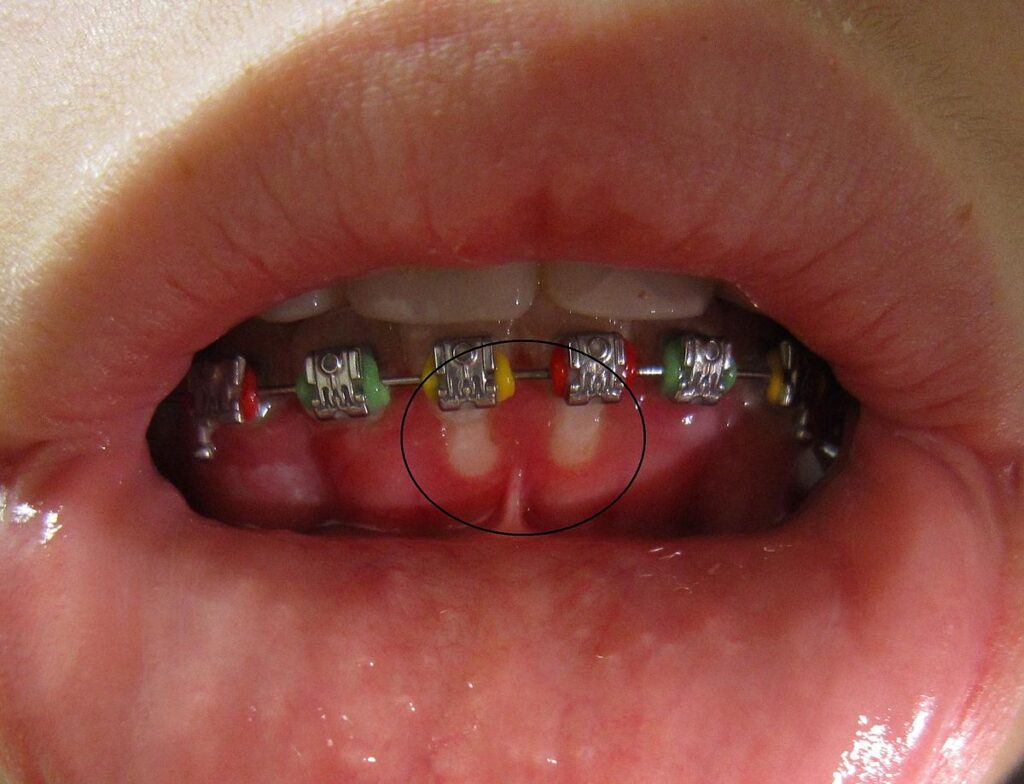 gingivostomatitis