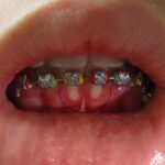 gingivostomatitis