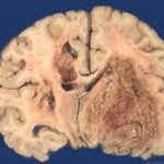 glioblastoma multiforme