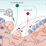 glucocorticoid induced osteoporosis