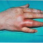 gonococcal arthritis