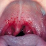 gonococcal pharyngitis