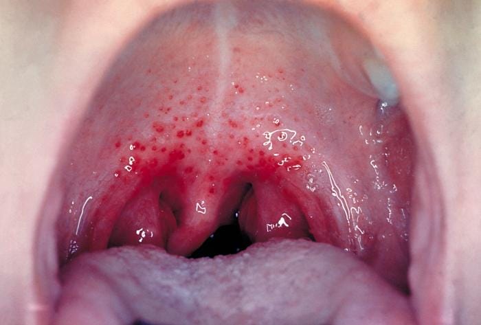 gonococcal pharyngitis