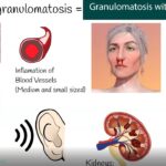 granulomatosis with polyangiitis