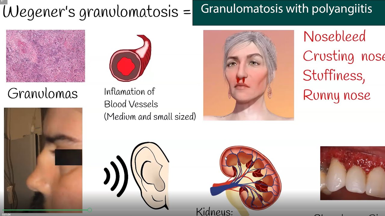 granulomatosis with polyangiitis