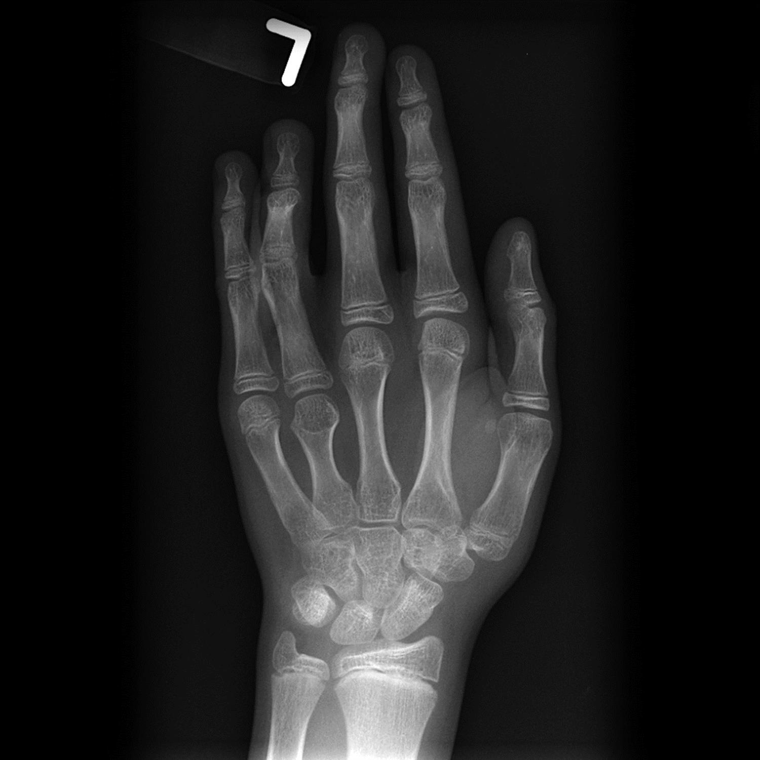 growth failure associated with turner's syndrome