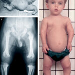 growth failure due to achondroplasia