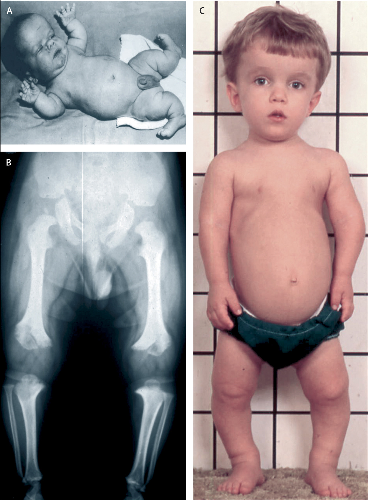 growth failure due to achondroplasia