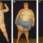 growth failure due to prader-willi syndrome