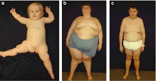 growth failure due to prader-willi syndrome