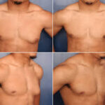 gynecomastia