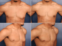 gynecomastia