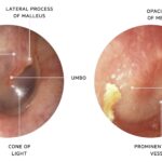 haemophilus influenzae acute otitis media