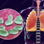 haemophilus influenzae bronchitis