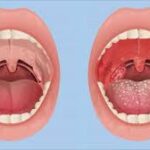 haemophilus influenzae pharyngitis