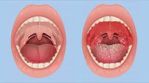 haemophilus influenzae pharyngitis