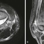 haemophilus osteomyelitis