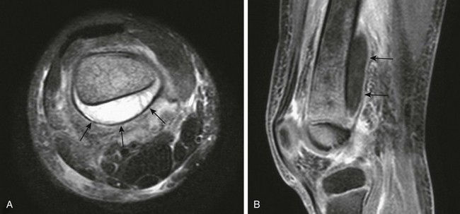 haemophilus osteomyelitis