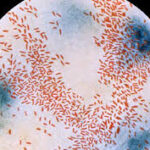 haemophilus parahaemolyticus pneumonia