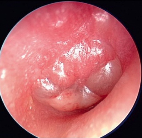 haemophilus parainfluenzae acute otitis media