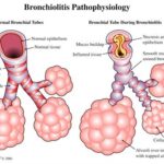 haemophilus parainfluenzae bronchitis