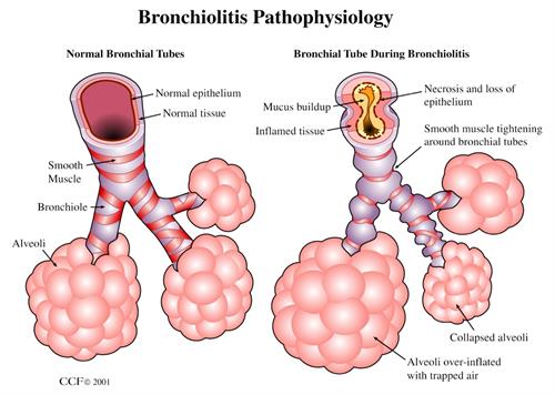 haemophilus parainfluenzae bronchitis