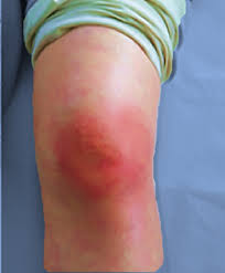 haemophilus septic arthritis